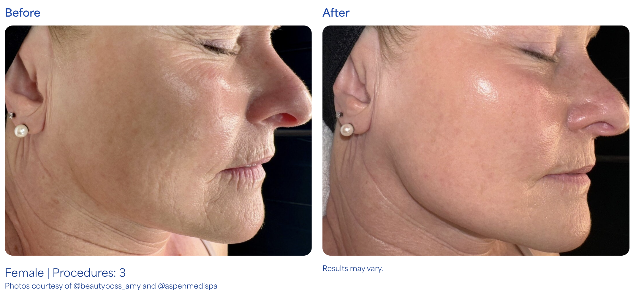 Before and After Pen Microneedling in Anchorage Alaska